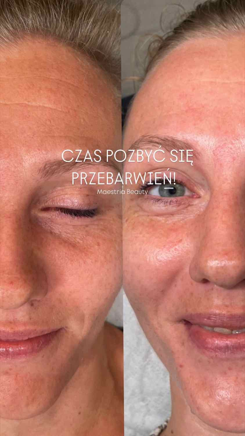 Efekt zabiegu — Maestria Beauty