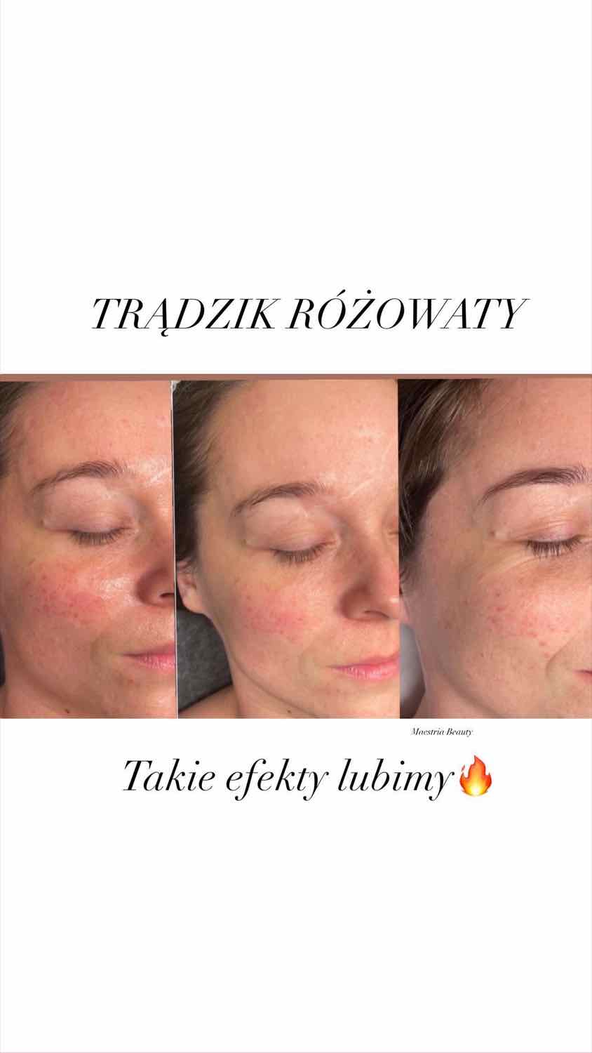 Efekt zabiegu — Maestria Beauty